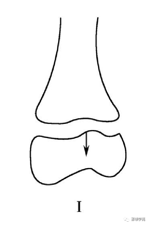 收藏 一文读懂骨骺损伤分型 关节