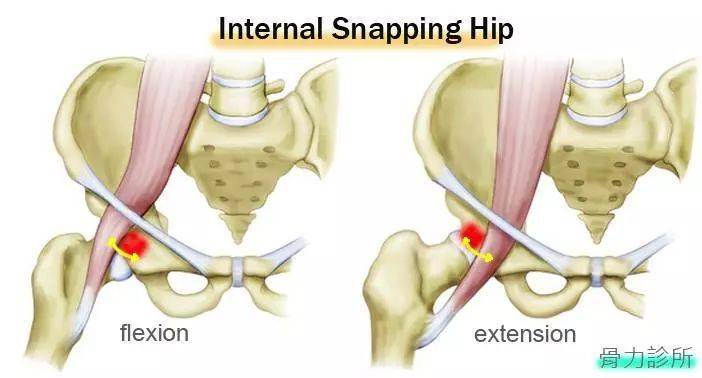 你可能已经患上髂腰肌综合症赶紧来学学怎么处理