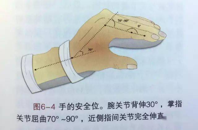 我们推荐术后将手固定于安全位,即腕关节背伸30°,掌指关节屈曲70