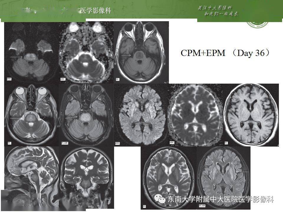 脑桥中央髓鞘溶解症影像表现