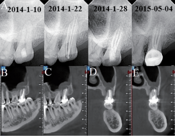 颌骨骨髓炎影像图片