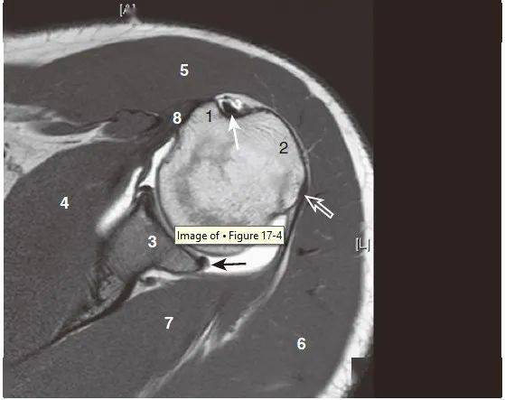 盂肱韧带mri解剖图片
