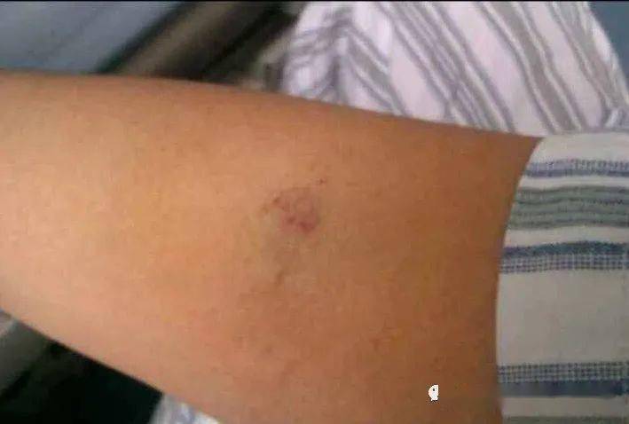 这样的采血后淤血你怕了吗