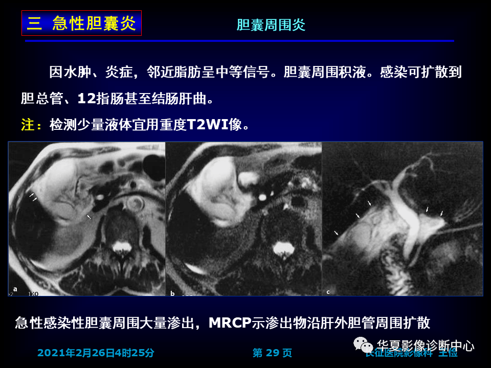 胆囊炎影像诊断