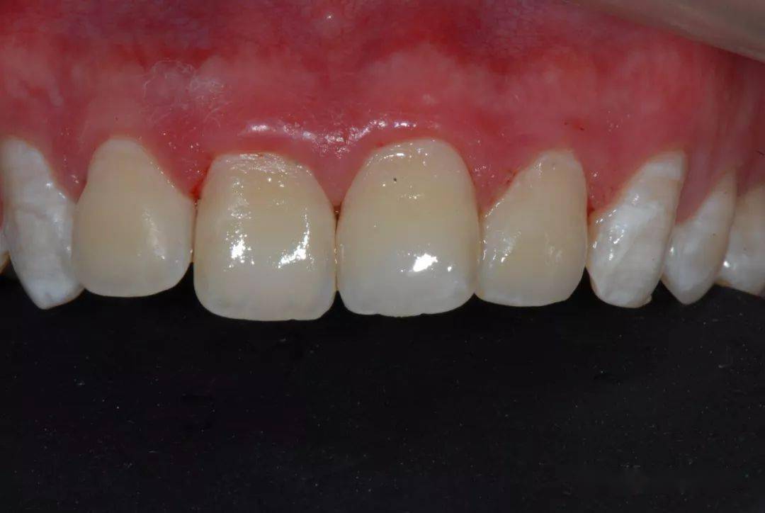 【病例分享】渗透树脂治疗氟斑牙前牙一例_釉质