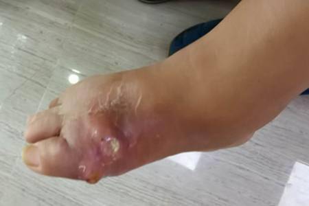 敢手挤痛风石这四大严重后果了解下