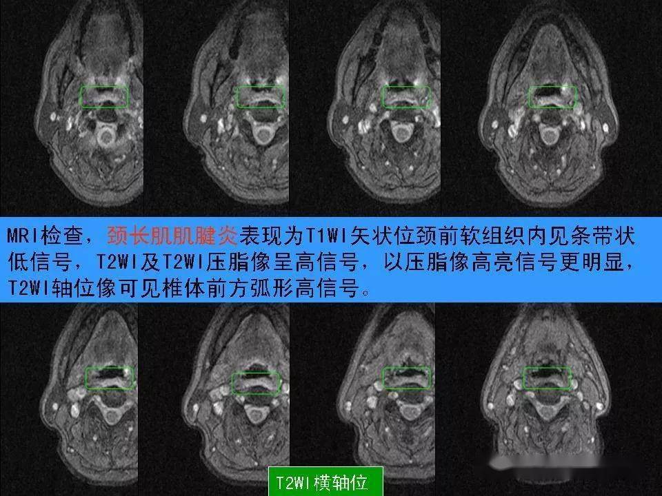 頸椎mri椎體前緣的條狀高信號影,終於知道是什麼啦