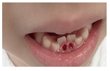 儿童双排牙怎么治疗图片