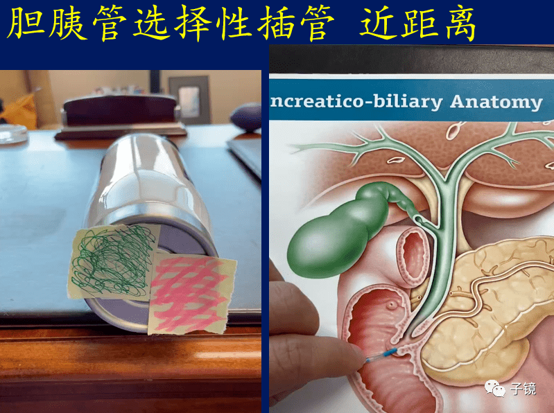 郦枫教授ercp插管理念及技巧学习笔记2020浙江国际eus学术大会