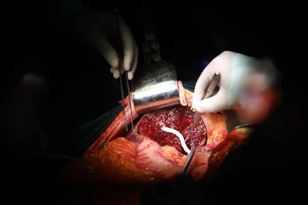 一个肝劈给两个成人树兰医院劈离式肝移植技术新突破