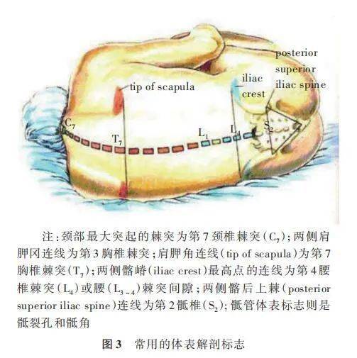 硬膜外麻醉侧入法图谱图片