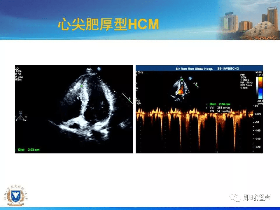 左室肥厚的超声心动图诊断思路