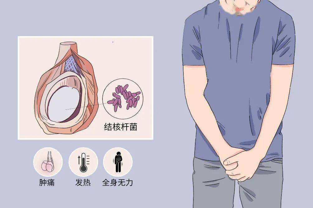 图片来源于网络姚碧波介绍,睾丸结核的患者可分为局部症状和全身症状