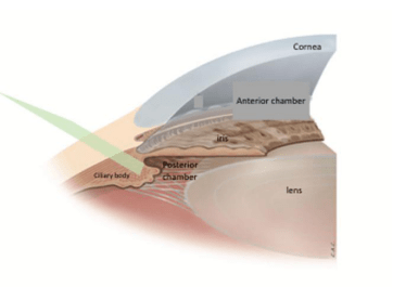 图4. 睫状体光凝术参考文献:https://www.glaucomapatients.