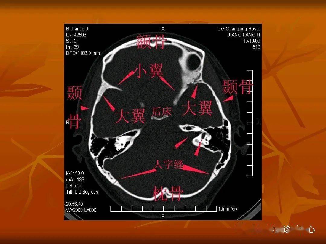 颅底ct断层解剖骨窗图片