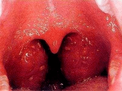 如何快速解决扁桃体痛 97ad3449f2a94d3eb299932237ff2b46.png