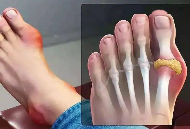 教你如何科学防治痛风_尿酸