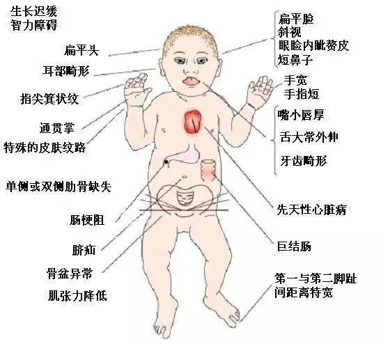 唐氏综合征怎么治疗图片