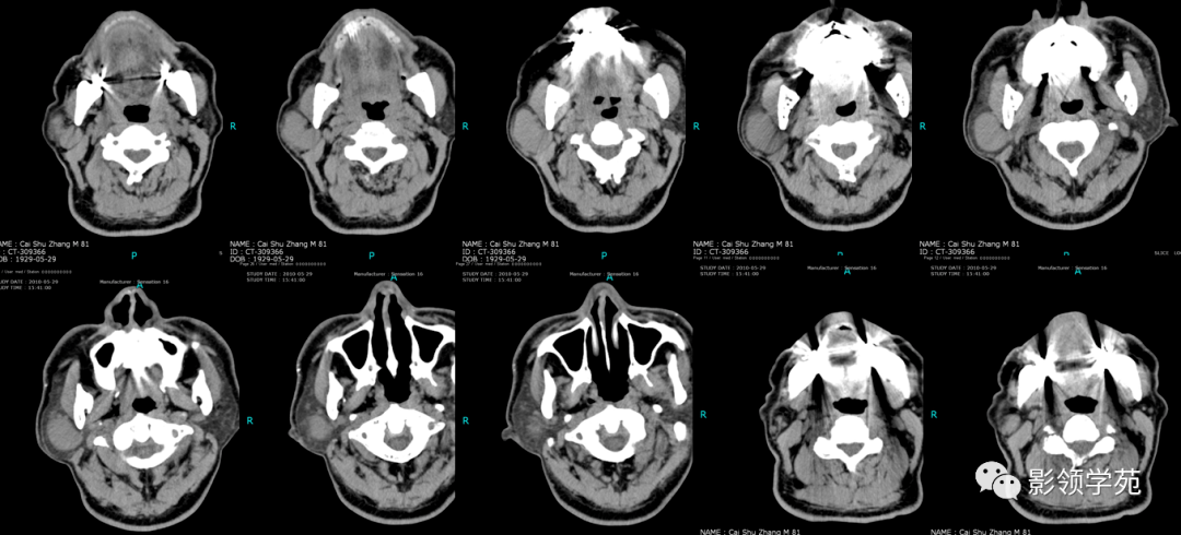 腮腺疾病的ct诊断与鉴别诊断