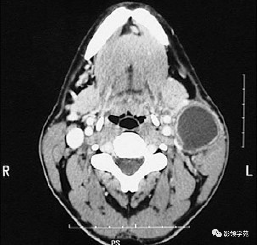 腮腺解剖结构图CT图片