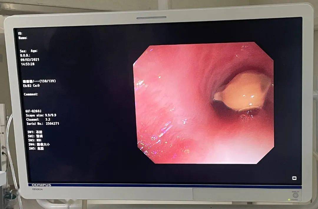 "赵先生的食管疤痕增生严重,这可能与长期反复放置胃管刺激食管黏膜有