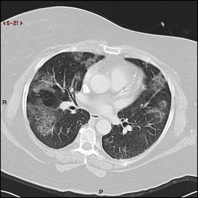 胸部ct 弥漫或多发磨玻璃影的影像鉴别诊断_肺泡