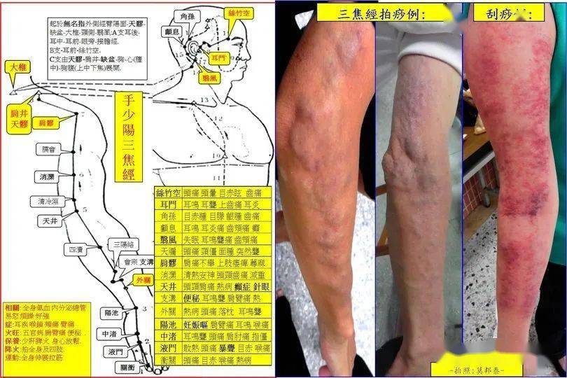 手少阳三焦经拍痧