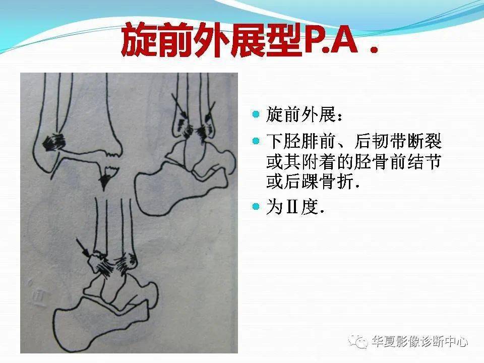 踝關節骨折的分型