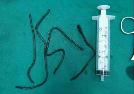 你永远想象不到,医生会在病人的尿道里取出什么._异物