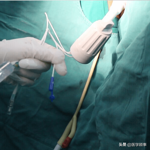 如做腹腔镜子宫切除手术,子宫不大的病患可直接牵引把手从阴道带出