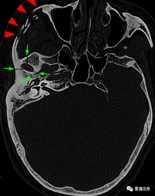 右侧颧弓骨折(红箭),注意对照前文的解剖标注图里的标注区2,颞骨与