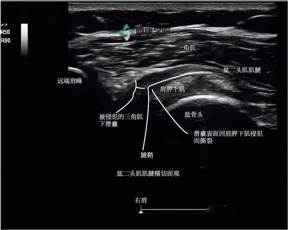 疼痛解剖學肱二頭肌肌腱半脫位綜合徵彈響試驗