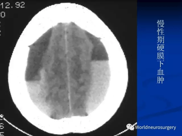 影像醫生必須掌握的頭顱ct解剖與常見出血梗死判讀