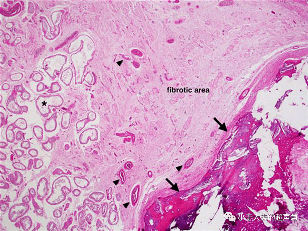 与表皮样囊肿相邻处,见纤维化区(fibrotic area,内见僵硬的生精小管