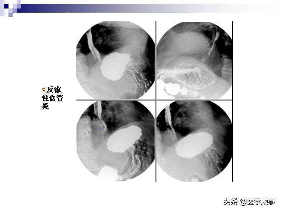 食道癌科普及影像分析
