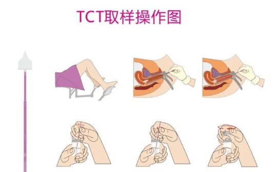 它与传统的宫颈刮片巴氏涂片相比,可明显提高标本的满意度及宫颈异常
