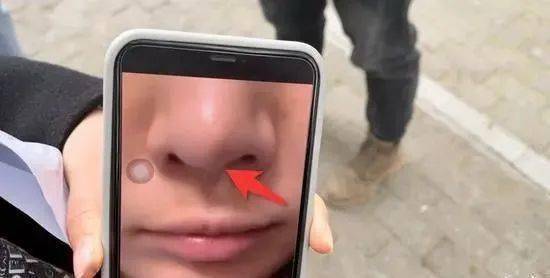 记者看到图片中的鼻尖软骨向右侧鼻孔倾斜