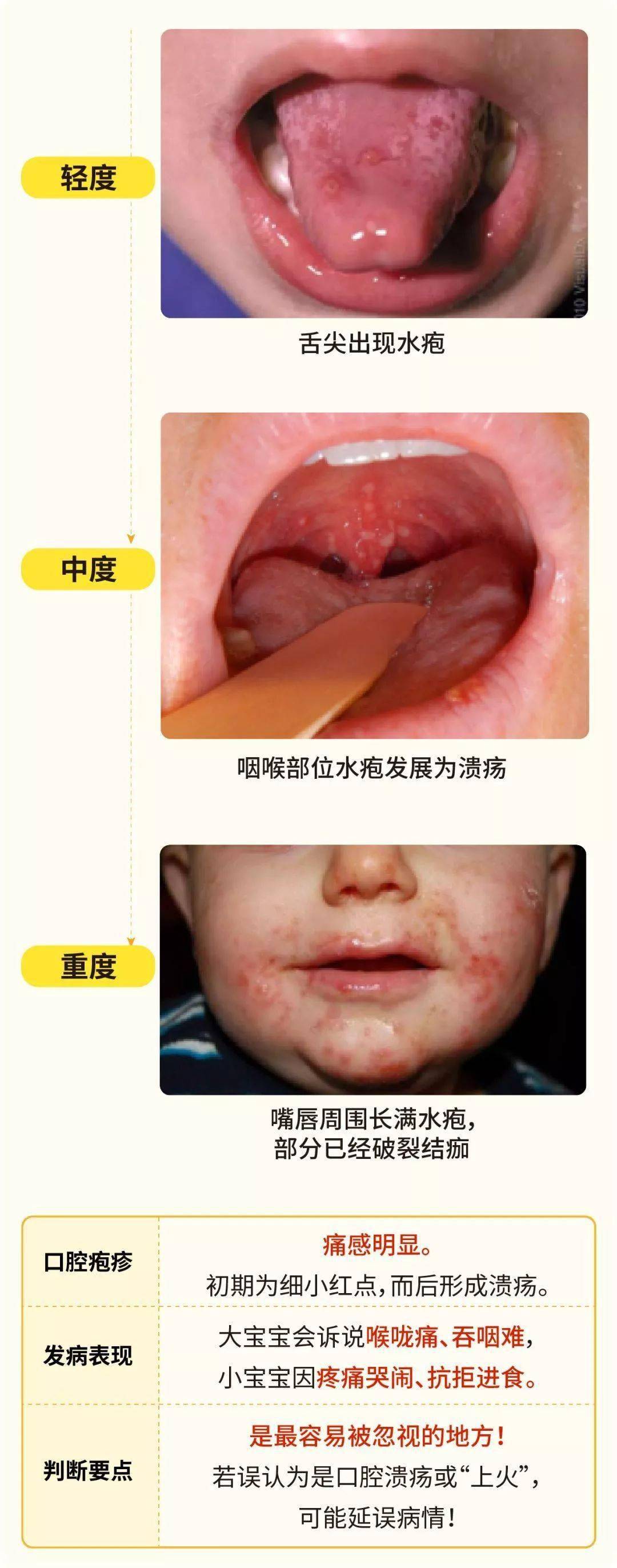 热疹图片初期症状图片 婴儿热疹症状（崔玉涛问答：宝宝身上起了这种小红点该怎么办？） | 说明书网