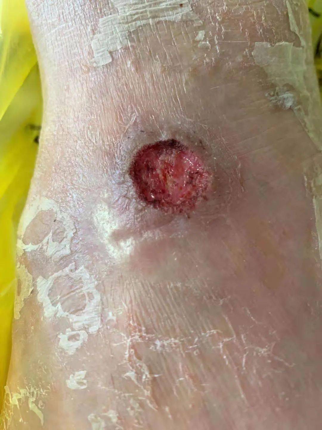 糖尿病足病是糖尿病最常见的并发症之一,疮面一旦