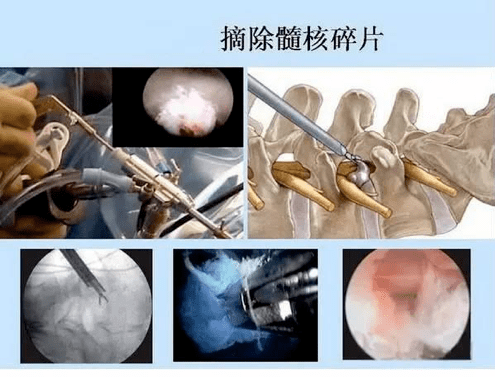 间盘突出腰剧痛,孔镜微创显神功_手术
