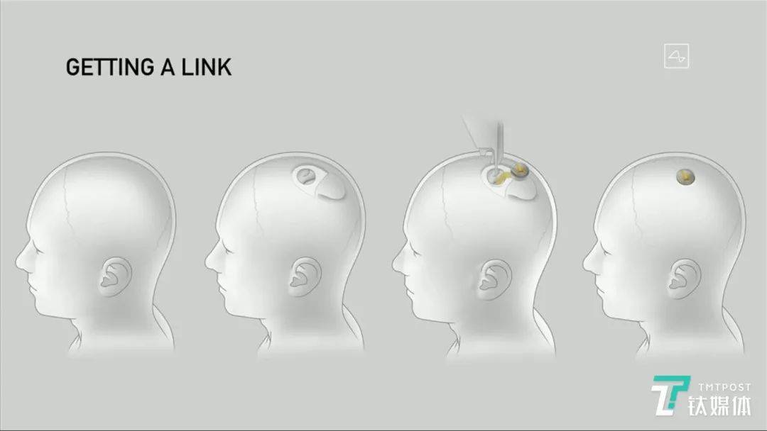 团队|马斯克脑机接口最新突破：猴子用意念玩游戏