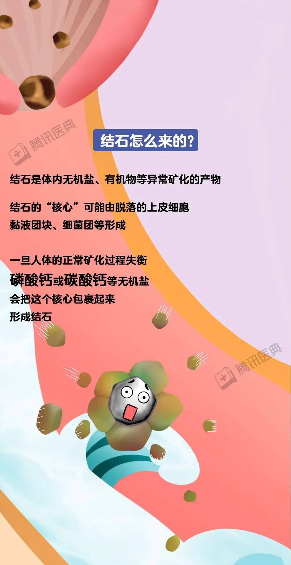 唾液腺结石怎么挤出来图片