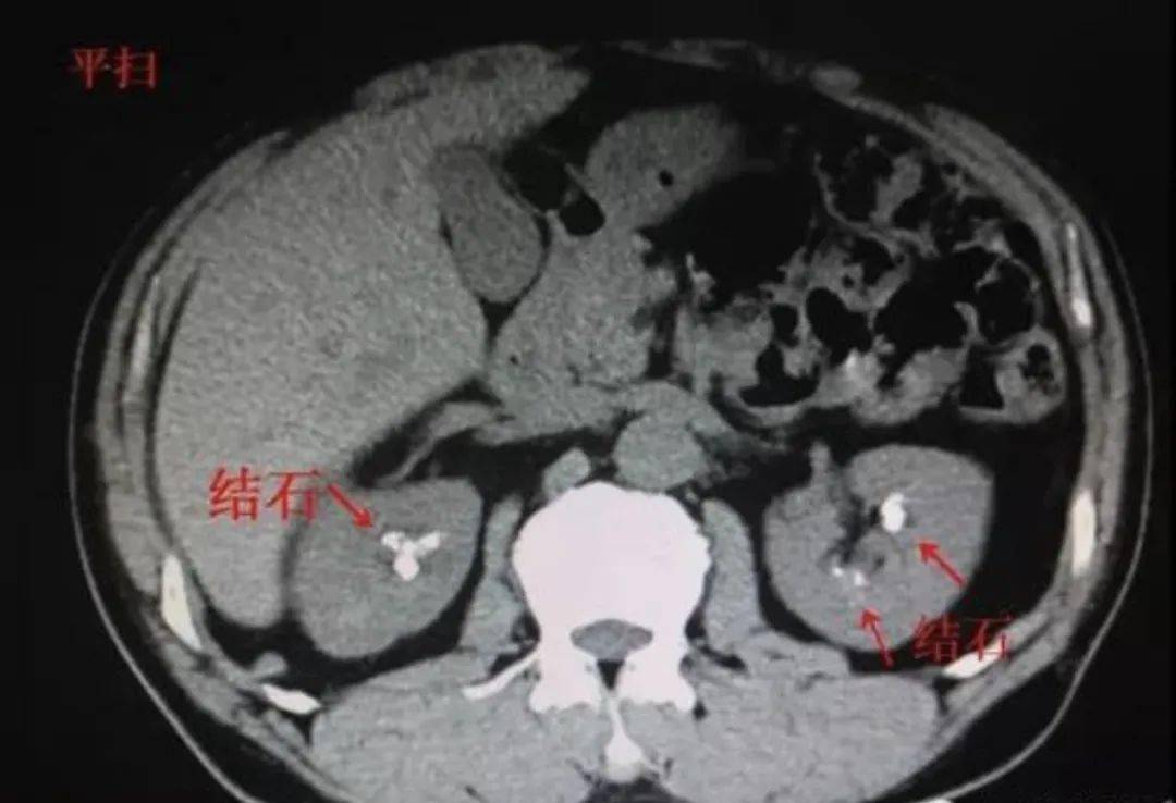 痛风肾超声表现图片