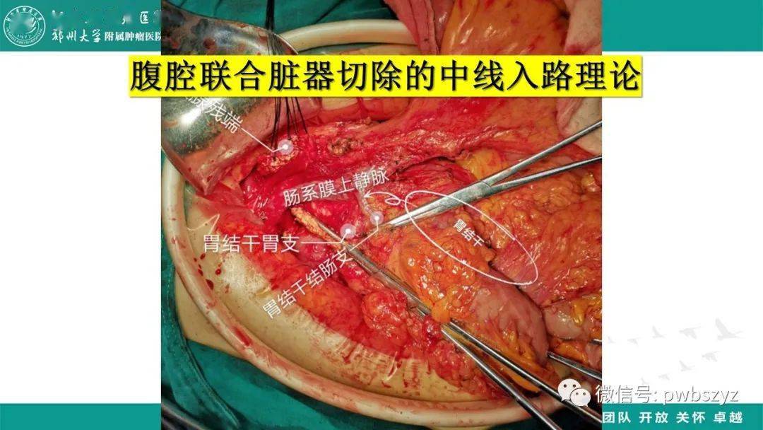 右半结肠联合胰十二指肠切除术的若干细节优化探讨