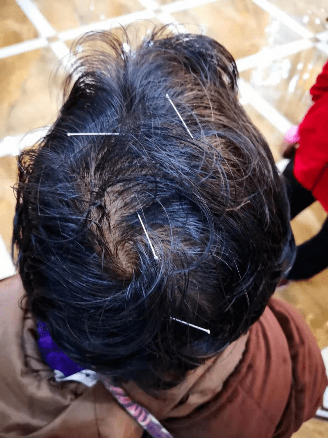 中风后语言障碍3年余中医针灸治愈