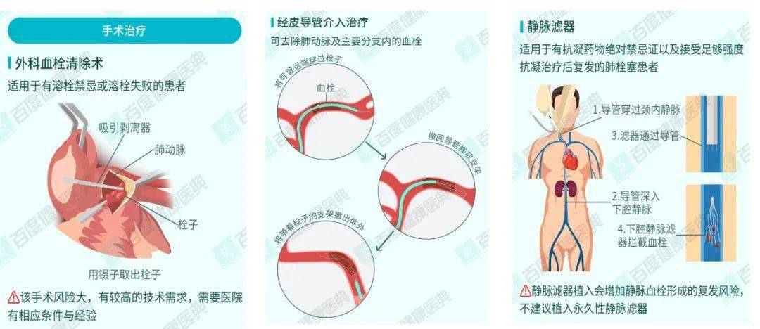 如何预防肺栓塞 1:基本预防:戒烟少酒,多运动少久坐,保持健康体重