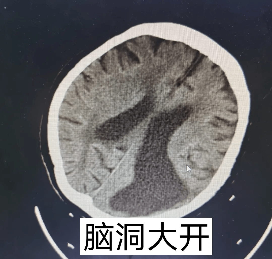 (图为食管裂孔疝,胸腔胃)(上图为右肾铸形结石,下图为左侧脑出血)(图