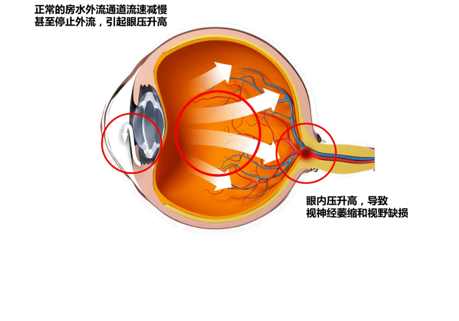 超过视神经所能耐受的程度,而引起视神经损害和视野缺损的一类不可逆