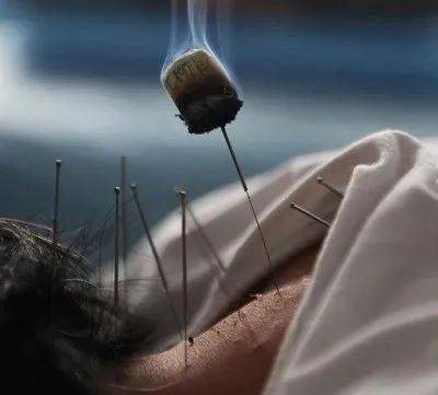 温针灸——针刺与艾灸相结合的神奇疗法