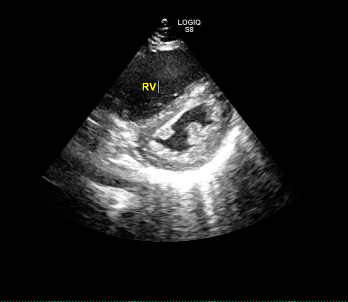 超声提示患者右心室增大划重点03治疗!